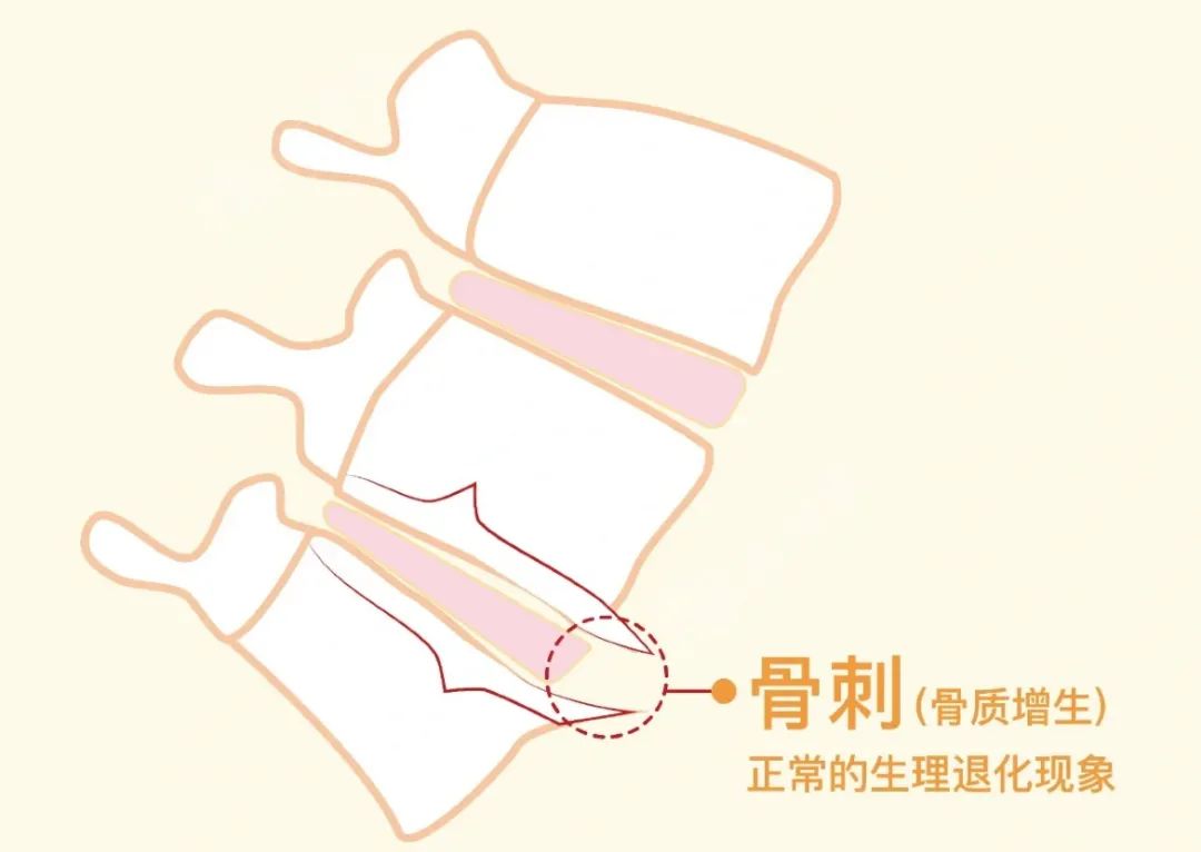 骨刺.jpg